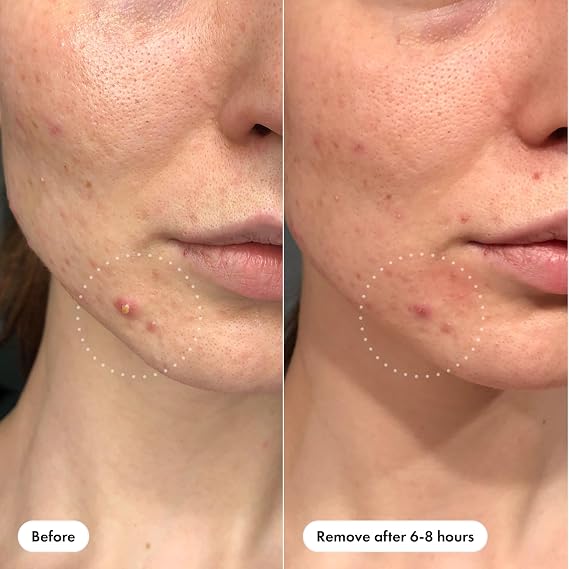 ClearSkin™ Hydrocolloid Acne Patches | Fast-Acting Spot Treatment